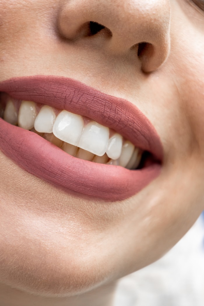 Close-up de sorriso com dentes clareados