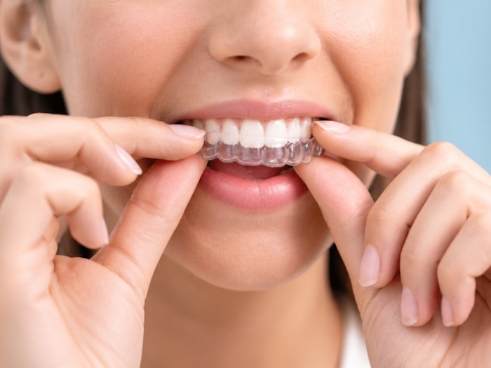 Paciente colocando alinhador dental transparente nos dentes